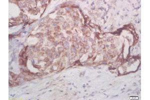 Formalin-fixed and paraffin embedded human breast cancer labeled with Rabbit Anti-AKT1/2/3 (Thr305/308/309) Polyclonal Antibody, Unconjugated (ABIN756052) at 1:200 followed by conjugation to the secondary antibody and DAB staining (AKT 1/2/3 antibody  (pThr305, pThr308, pThr309))