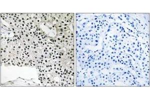 Immunohistochemistry analysis of paraffin-embedded human breast carcinoma, using TCEAL4 Antibody. (TCEAL4 antibody  (AA 166-215))