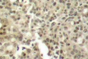 Immunohistochemistry (IHC) analyzes of PKC delta antibody in paraffin-embedded human breast carcinoma tissue. (PKC delta antibody)
