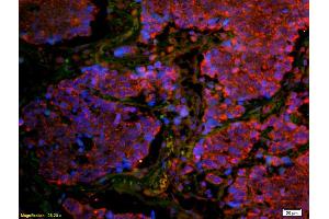 Formalin-fixed and paraffin embedded human lung carcinoma labeled with Anti-CD8B Polyclonal Antibody, Unconjugated (ABIN1387300) at 1:200 followed by secondary antibody was Goat Anti-Rabbit IgG, Cy3 conjugated used at 1:200 dilution for 40 minutes at (CD8B antibody  (AA 51-150))