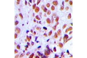 Immunohistochemical analysis of RAD21 staining in human breast cancer formalin fixed paraffin embedded tissue section.