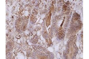 Immunohistochemistry staining of colorectal carcinoma (paraffin-embedded sections) with anti-human CD66e (CB30). (CEACAM5 antibody)