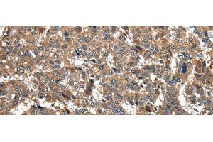 Immunohistochemistry of paraffin-embedded Human liver cancer tissue using PIWIL2 Polyclonal Antibody at dilution of 1:30(x200) (PIWIL2 antibody)