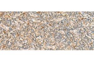 Immunohistochemistry of paraffin-embedded Human tonsil tissue using TBCK Polyclonal Antibody at dilution of 1:25(x200) (TBCK antibody)