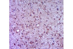 Paraformaldehyde-fixed, paraffin embedded human brain glioma, Antigen retrieval by boiling in sodium citrate buffer (pH6. (G-CSF antibody  (AA 155-198))