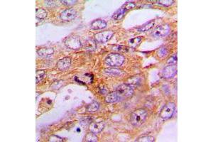 Immunohistochemical analysis of Caspase 9 staining in human lung cancer formalin fixed paraffin embedded tissue section.