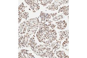 Immunohistochemical analysis of paraffin-embedded Human breast carcinoma tissue using (ABIN6243675 and ABIN6577401) performed on the Leica® BOND RXm. (GLI2 antibody  (C-Term))