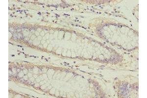 Immunohistochemistry of paraffin-embedded human colon cancer using ABIN7144813 at dilution of 1:100 (ATL2 antibody  (AA 1-300))