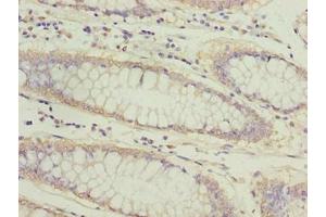 Immunohistochemistry of paraffin-embedded human colon cancer using ABIN7144813 at dilution of 1:100 (ATL2 antibody  (AA 1-300))