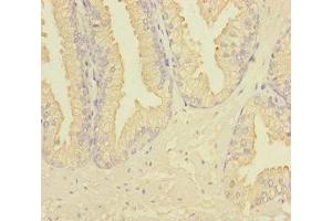 Immunohistochemistry of paraffin-embedded human prostate cancer using ABIN7167274 at dilution of 1:100 (RAB27B antibody  (AA 1-218))