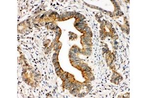 IHC-P: Integrin alpha 3 antibody testing of human intestinal cancer tissue (ITGA3 antibody  (N-Term))
