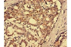 Immunohistochemistry analysis of human breast cancer using ABIN7168686 at dilution of 1:100 (SFRP4 antibody  (AA 293-346))