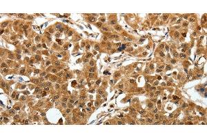 Immunohistochemistry of paraffin-embedded Human lung cancer using SOX-13 Polyclonal Antibody at dilution of 1:50 (SOX13 antibody)