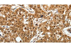 Immunohistochemistry of paraffin-embedded Human lung cancer using SOX-13 Polyclonal Antibody at dilution of 1:50