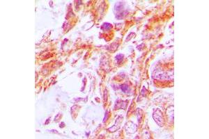 Immunohistochemical analysis of Caspase 8 staining in human lung cancer formalin fixed paraffin embedded tissue section. (Caspase 8 antibody  (Center))