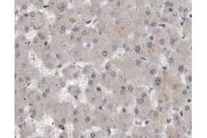 ABIN6267594 at 1/200 staining human liver cancer tissue sections by IHC-P. (MEK1 antibody  (pSer221))