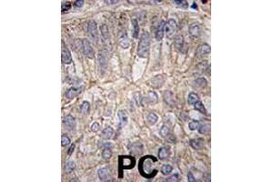 Formalin-fixed and paraffin-embedded human prostate carcinoma tissue reacted with CDH3 polyclonal antibody  , which was peroxidase-conjugated to the secondary antibody, followed by DAB staining. (P-Cadherin antibody  (C-Term))