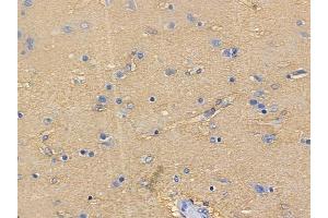 ABIN6261423 and ABIN6272638 at 1/100 staining human glioblastoma by IHC-P. (ECM1 antibody  (C-Term))