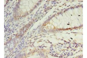 Immunohistochemistry of paraffin-embedded human colon cancer using ABIN7172922 at dilution of 1:100 (SSR3 antibody  (AA 77-135))