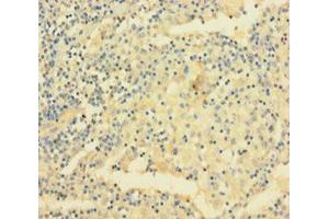 Immunohistochemistry of paraffin-embedded human lung cancer using ABIN7175481 at dilution of 1:100 (VAMP5 antibody  (AA 1-72))