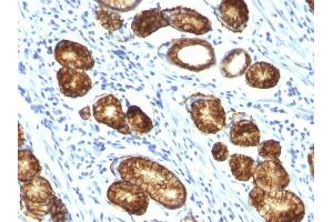 Formalin-fixed, paraffin-embedded human Gastric Carcinoma stained with MUC6 Monoclonal Antibody (MUC6/916). (MUC6 antibody)