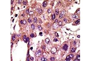 IHC analysis of FFPE human hepatocarcinoma stained with the AMFR antibod (AMFR antibody  (AA 571-601))