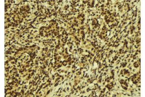 ABIN6274165 at 1/100 staining Human breast cancer tissue by IHC-P. (Topoisomerase II alpha antibody  (Internal Region))