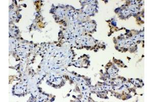 IHC testing of FFPE human lung cancer tissue with ETV6 antibody at 1ug/ml. (ETV6 antibody)