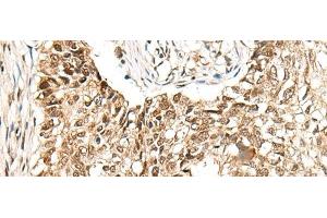Immunohistochemistry of paraffin-embedded Human lung cancer tissue using CCDC181 Polyclonal Antibody at dilution of 1:50(x200)