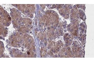 ABIN6272762 at 1/100 staining Human liver cancer tissue by IHC-P. (OR52N2 antibody  (C-Term))