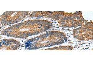 Immunohistochemistry of paraffin-embedded Human colorectal cancer tissue using HSD11B1 Polyclonal Antibody at dilution of 1:70(x200) (HSD11B1 antibody)