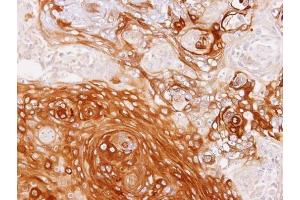 IHC-P Image Immunohistochemical analysis of paraffin-embedded SCC4 xenograft, using GBP1, antibody at 1:100 dilution. (GBP1 antibody  (Internal Region))