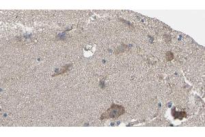 ABIN6275980 at 1/100 staining Human brain cancer tissue by IHC-P. (CNR1 antibody  (N-Term))