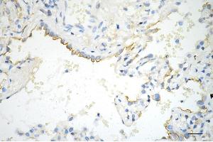 Immunohistochemistry was performed on paraffin-embedded human lung adenocarcinoma using phospho-EGFR (Y) antibody (ABIN7798468), 1:200). (Recombinant EGFR antibody  (pTyr1068))