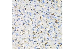 Immunohistochemistry of paraffin-embedded human liver damage using Somatostatin Receptor 2 (SSTR2) antibody (ABIN3017442, ABIN3017443, ABIN3017444 and ABIN6220093) at dilution of 1:100 (40x lens). (SSTR2 antibody  (C-Term))