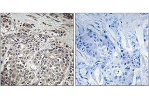 Immunohistochemistry analysis of paraffin-embedded human breast carcinoma tissue, using AMPK1 (Ab-485) Antibody. (PRKAA1 antibody  (AA 451-500))