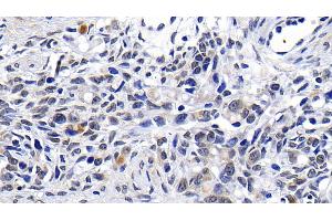 Detection of ATM in Human Ovarian cancer Tissue using Polyclonal Antibody to Ataxia Telangiectasia Mutated (ATM) (ATM antibody  (AA 2484-2748))