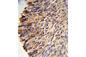 Formalin-fixed and paraffin-embedded human lung carcinoma reacted with BCL3 Antibody (Center), which was peroxidase-conjugated to the secondary antibody, followed by DAB staining.