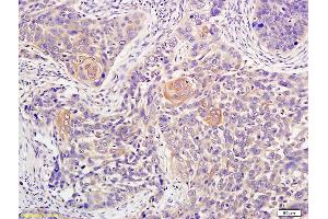 Formalin-fixed and paraffin embedded human lung carcinoma labeled with Anti-ATM Polyclonal Antibody, Unconjugated (ABIN685582) at 1:200 followed by conjugation to the secondary antibody and DAB staining (ATM antibody  (AA 2681-2750))