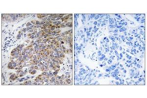 Immunohistochemistry analysis of paraffin-embedded human lung carcinoma tissue, using CHST10 antibody. (CHST10 antibody  (Internal Region))