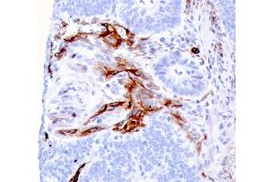 Formalin-fixed, paraffin-embedded human Colon Carcinoma stained with Nestin Mouse Monoclonal Antibody (NES/2911). (Nestin antibody  (AA 698-844))