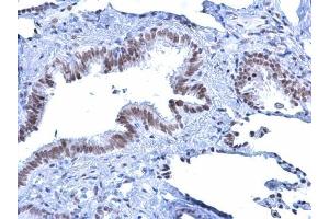 IHC-P Image Rad54 antibody [C3], C-term detects Rad54 protein at nucleus on human lung carcinoma by immunohistochemical analysis. (ATRX antibody  (C-Term))