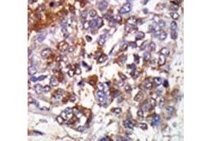 IHC analysis of FFPE human hepatocarcinoma stained with the cGKI beta antibody (PRKG1 antibody  (AA 629-660))