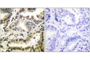 Immunohistochemistry analysis of paraffin-embedded human lung carcinoma tissue, using NF-kappaB p65 (Acetyl-Lys310) Antibody. (NF-kB p65 antibody  (acLys310))