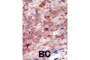 Formalin-fixed and paraffin-embedded human cancer tissue reacted with the primary antibody, which was peroxidase-conjugated to the secondary antibody, followed by DAB staining. (YWHAB antibody  (N-Term))
