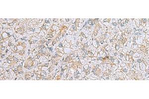 Immunohistochemistry of paraffin-embedded Human liver cancer tissue using LRRC49 Polyclonal Antibody at dilution of 1:40(x200) (LRRC49 antibody)