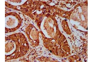 IHC image of ABIN7175679 diluted at 1:500 and staining in paraffin-embedded human cervical cancer performed on a Leica BondTM system.