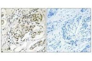 Immunohistochemistry analysis of paraffin-embedded human breast carcinoma tissue using CDYL2 antibody. (CDYL2 antibody  (N-Term))