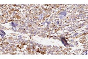 ABIN6277073 at 1/100 staining Human Melanoma tissue by IHC-P. (IL1RN antibody  (Internal Region))