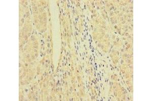 Immunohistochemistry of paraffin-embedded human liver cancer using ABIN7167064 at dilution of 1:100